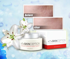 Best Stretch Marks Cream